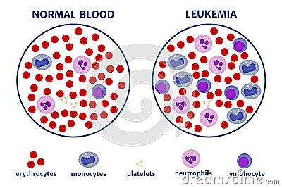 Leukemia. blood cancer. Vector Illustration